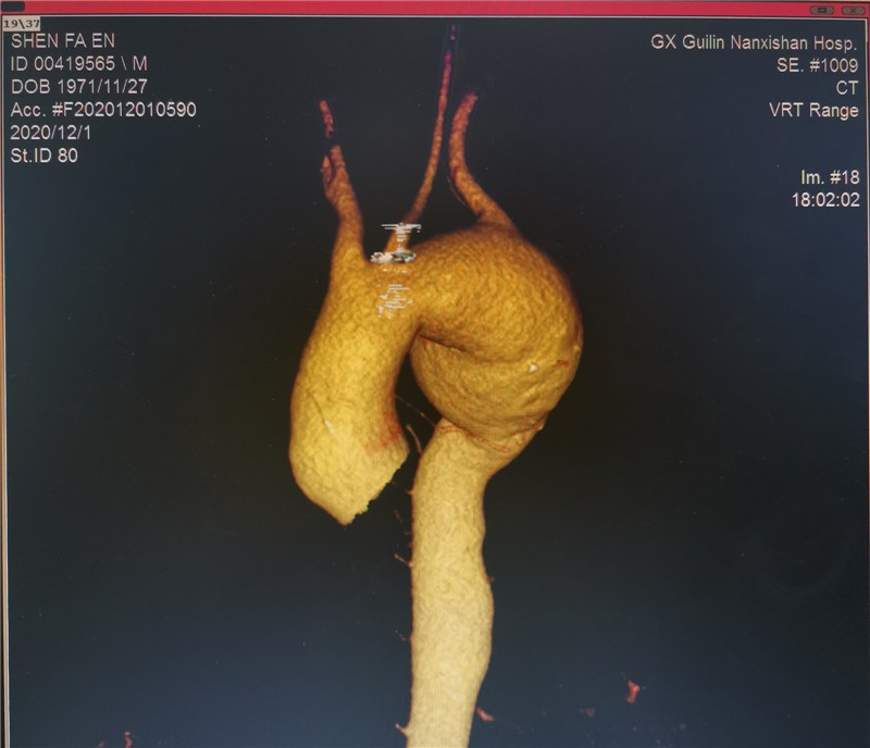 复件图片2:主动脉弓部血管瘤(术前CTA正面)