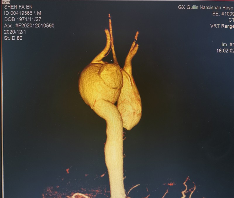 复件图片3:主动脉弓部血管瘤(术前CTA反面)
