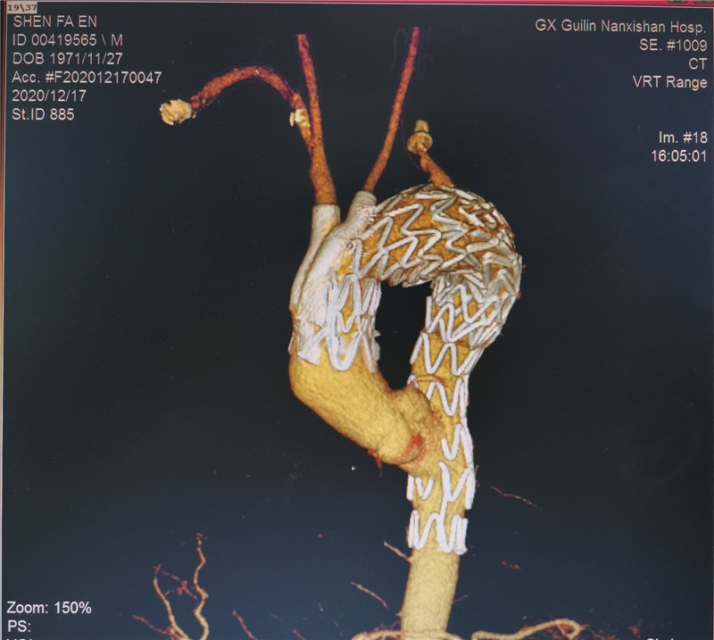 复件图片5:主动脉弓部血管瘤(术后CTA正面)