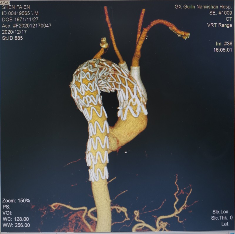 复件图片6:主动脉弓部血管瘤(术后CTA背面)