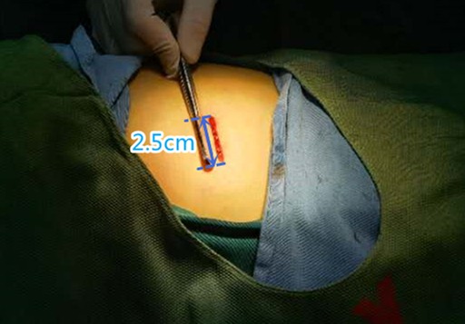 2.5厘米的微创伤口