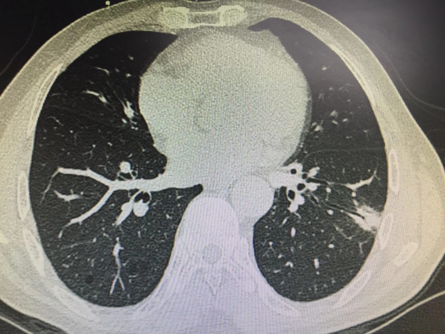 图2患者肺部CT照
