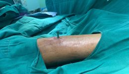 广西首例|自治区南溪山医院新技术造福糖尿病足患者