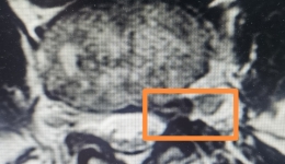 腰椎微创技术, 一根“细管”解决贫困户多年腰腿痛难题