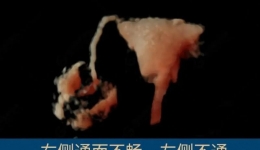 “一站式”子宫输卵管造影技术，助您好“孕”