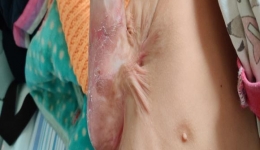 南溪山医院成功治愈一名烫伤导致功能障碍的幼儿