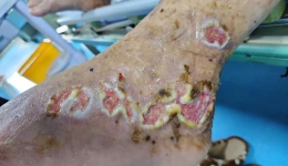 新技术治愈十几年老烂腿PRF让难愈伤口不再难  自治区南溪山医院成功开展烧伤整形与创面修复新技术