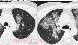 自治区南溪山医院成功为首例肺泡蛋白沉积症患者施行全肺灌洗术