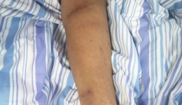 小小球囊还血液透析患者通畅“生命线”