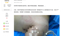 鱼刺扎伤后果严重，学科合作凸显神效