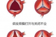 心脏瓣膜坏了一定要换吗？