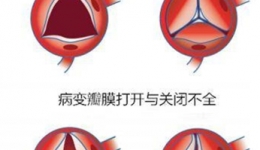 心脏瓣膜坏了一定要换吗？
