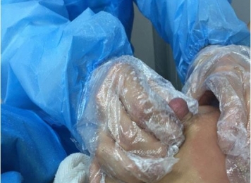 产后乳腺疏通、催乳、回乳