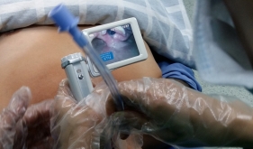 可视化气管插管