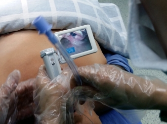 可视化气管插管