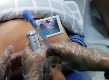 可视化气管插管