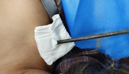 险！钢筋穿胸而过！幸！联合施救保无虞