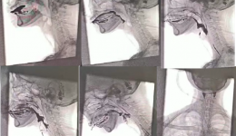 吞咽造影检查 保障患者“吃”得放心