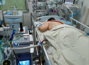 ECMO技术+俯卧位通气