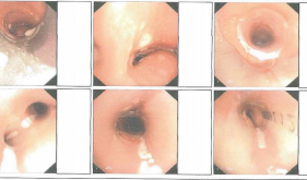 硬镜+硅酮支架植入术