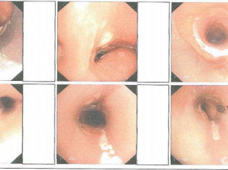 硬镜+硅酮支架植入术