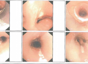 硬镜+硅酮支架植入术