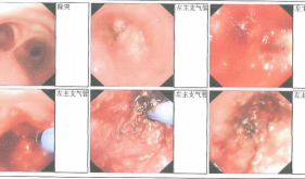 左主新生物切除、APC、冷冻
