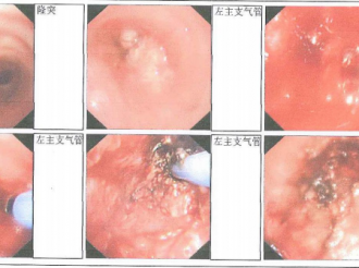 左主新生物切除、APC、冷冻