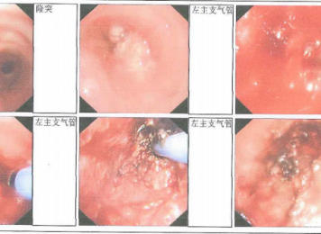 左主新生物切除、APC、冷冻