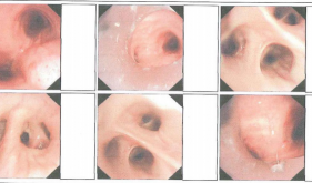 困难气道硬镜+冷冻肺活检