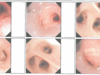 困难气道硬镜+冷冻肺活检
