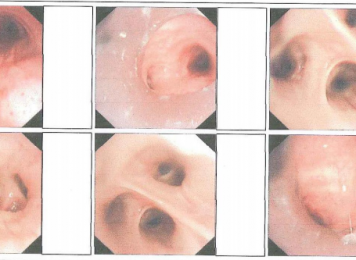 困难气道硬镜+冷冻肺活检