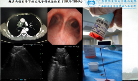 超声内镜引导下经支气管针吸活检术