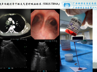 超声内镜引导下经支气管针吸活检术