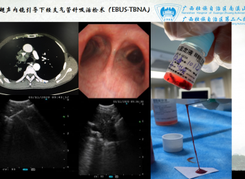 超声内镜引导下经支气管针吸活检术