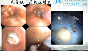 气管镜下药物注射术