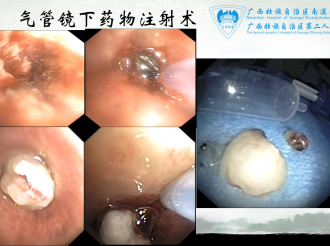 气管镜下药物注射术