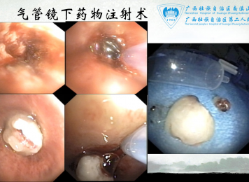 气管镜下药物注射术