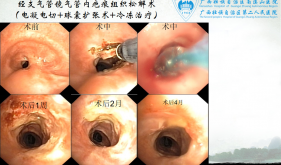 经支气管镜气管内疤痕组织松懈术