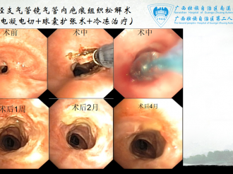 经支气管镜气管内疤痕组织松懈术