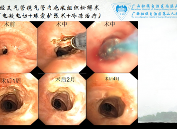 经支气管镜气管内疤痕组织松懈术