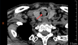 老人中秋节犯病  医生巧解定时炸弹