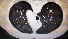 肿瘤细胞被细针打败 微波肺消融术——治愈肺小结节的新希望