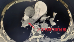 下肢肿胀也致命  医生明断抢生机
