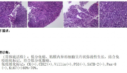 双侧卵巢转移性腺癌，PET/CT找“真凶”