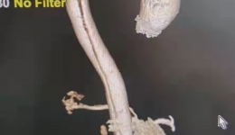 南溪山医院“拆弹部队”争分夺秒，开放主动脉夹层绿色通道