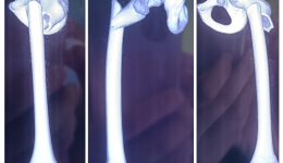 10岁幼儿车祸致股骨转子下骨折，3D打印钢板治疗“一箭三雕” 广西首例  南溪山医院运用3D打印钢板治疗小儿股骨转子下骨折