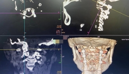 南溪山医院3D打印技术助力颈椎手术实现新突破