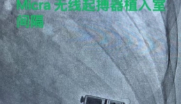 前沿技术|南溪山医院成功完成首例Micra无导线起搏器植入术
