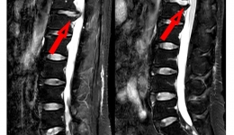 椎间孔镜解决临床少见椎间盘突出